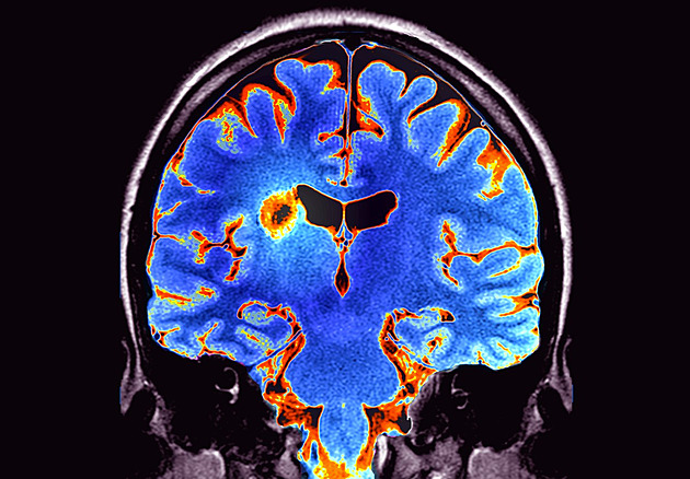 Roztroušená skleróza: nemoc, která zasahuje mozek i míchu. Jak ji poznat